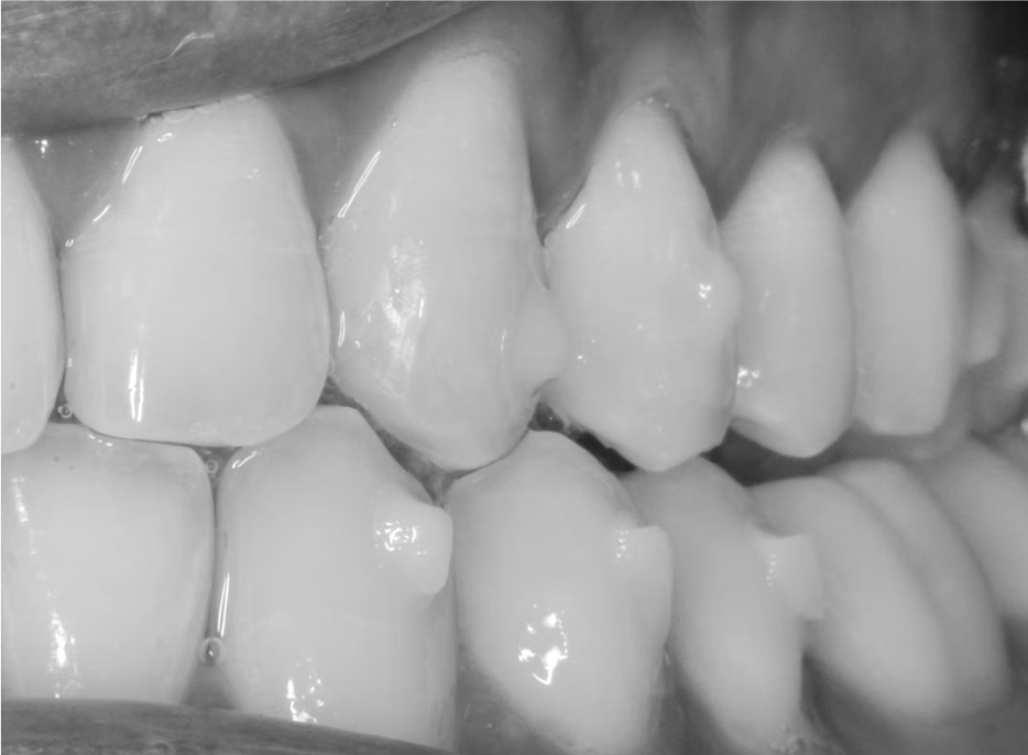 Vì sao attachment quyết định thành công trong điều trị bằng khay trong suốt?